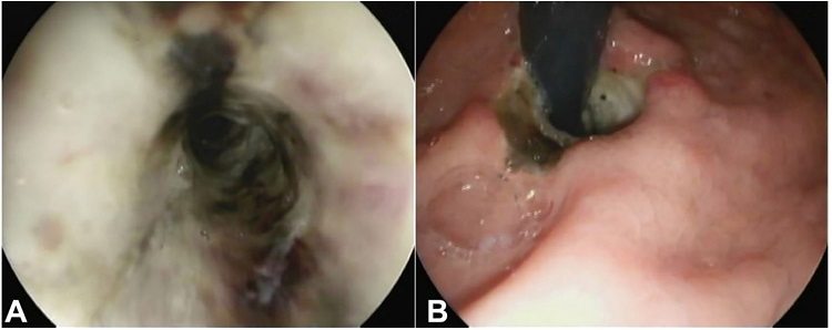 A &ndash; Upper endoscopy showing ischemic mucosa; B &ndash; Gastroesophageal transition revealing an ischemic esophageal mucosa.