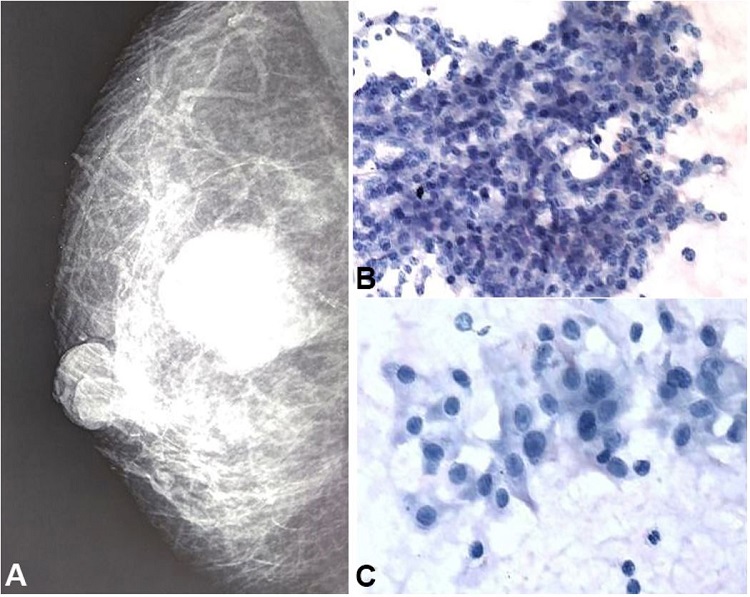 Mammography and photomicrographs of the aspiration smears. A &ndash; Well defined, sub-areolar, radio-opaque lesion within the breast; B &ndash; Cohesive clusters of tumor cells (Giemsa, 100X); C &ndash; Mildly pleomorphic polygonal tumor cells with centrally placed nuclei in a fluid background (Giemsa, 400X).