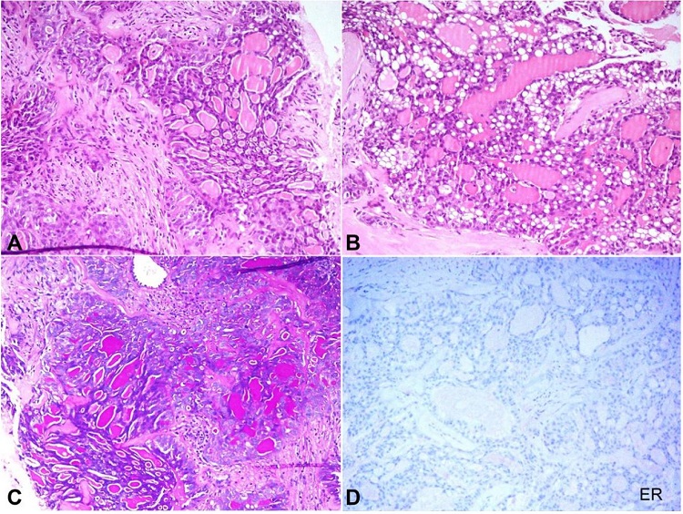 Photomicrography of the tumor. A &ndash; Microcystic and follicular arrangement of the tumor cells with eosinophilic extracellular secretion (H&E, 100X); B &ndash; Intracellular vacuolation and eosinophilic secretion (H&E, 200X); C &ndash; Magenta colored secretion for Periodic acid Schiff stain (H&E, 100X); D &ndash; No positivity for ER immunostain (200X).