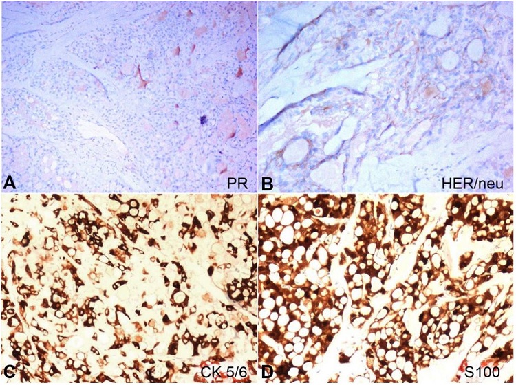 Photomicrography of the tumor: A &ndash; No reactivity to PR (100X), B &ndash; negative reaction to HER2/neu (200X); C &ndash; Diffuse membranous and cytoplasmic positivity for cytokeratin 5/6 (400X); D &ndash; Diffuse membranous and cytoplasmic positivity for S100-P (400X).