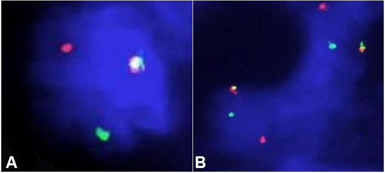 Photomicrography of FISH analysis. A &ndash; FISH analysis by dual-color break apart ETV6 probe. One fusion signal (red/green/yellow; arrowed) and one split (rearrangement) signal in the nucleus (400X); B &ndash; FISH analysis by dual-color break apart NTRK3 probe. Two fusion signal (red/green/yellow; arrowed) and two splits (rearrangement) signal in the nucleus (100X).
