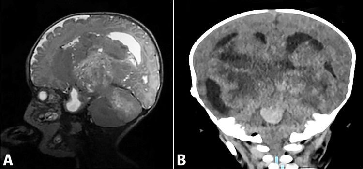 A &ndash; Magnetic resonance imaging, sagittal section: T2 sequence shows a heterogeneous cystic mass causing important dilatation of the ventricle system; B &ndash; Computed tomography of the coronal section, parenchymal (brain) window: shows a heterogeneous cystic mass causing important dilatation of the ventricle system.