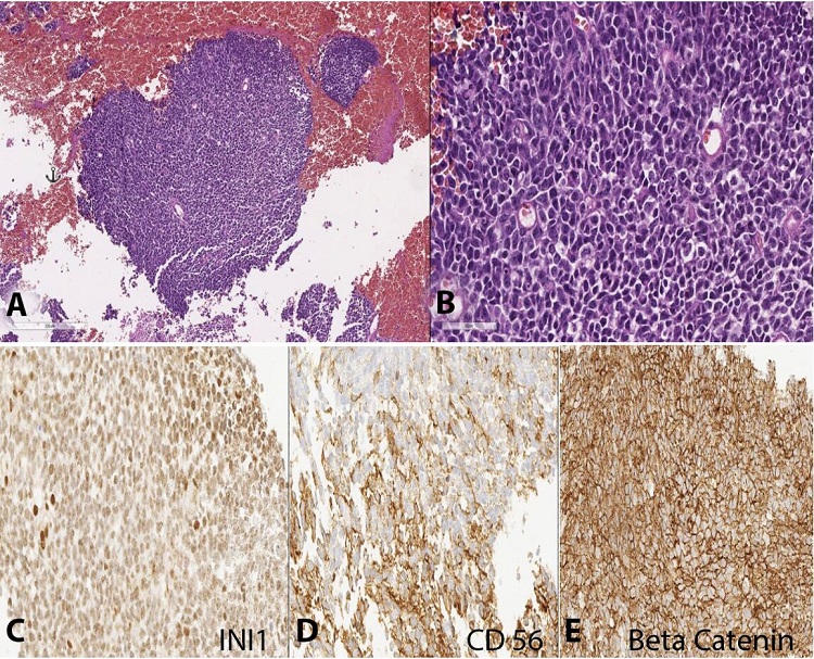 Photomicrographs of the brain tumor. A &ndash; Large sheets of small, round cells can be observed in the complete absence of any other components (H&E, 10X); B &ndash; High nuclear/cytoplasmic ratio, nuclear molding, and variability in the shape of nuclei are evident in this hypercellular neoplasm rendering a primitive, embryonal appearance (H&E, 40X); C &ndash; Retained INI1 (40X); D &ndash; Focal and partial reactivity for CD 56 in the neoplastic cells (40X); E &ndash; Beta-catenin membrane stain was positive (40X). c-MYC was negative. Additional stains for synaptophysin (focally positive), CD99 (negative), and KI67 (positive, 70%) were performed.