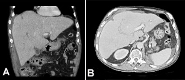 A and B - High-resolution abdominal CT showing hepatomegaly with diffuse inhomogeneous parenchyma, extensive periaortic lymph nodes involvement, and ascites.