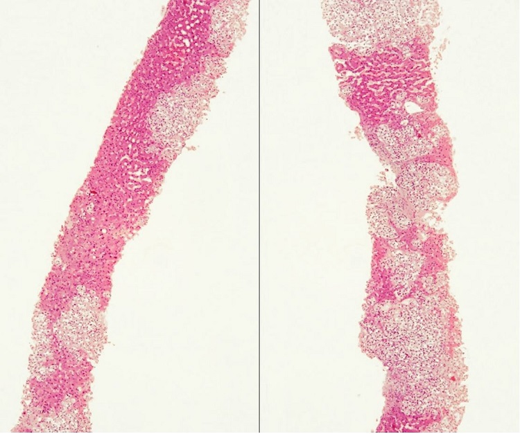 Photomicrograph of the liver biopsy showing diffuse liver infiltration by metastatic urothelial carcinoma. (H&E; 40x).