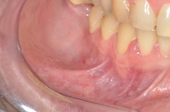 Intraoral examination revealed a healthy oral mucosa.
