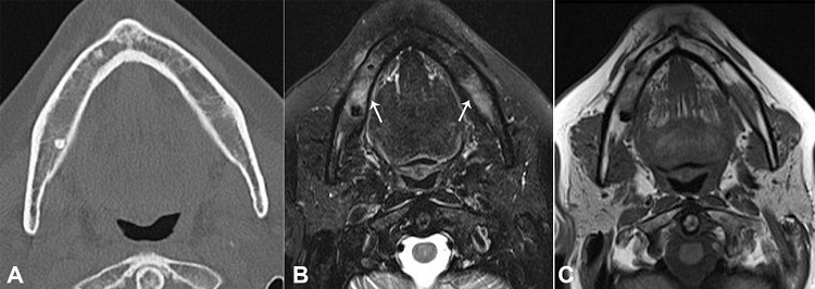 A – Computed tomography of the mandible (axial plane) - note a reduction of bone trabeculations in the mandibular body, possibly related to infiltration; B and C – Axial plane of MRI with bilateral mandibular bone marrow signal alteration (arrows); B – T2 high signal tissue near the right mental foramen related to the involvement of the inferior alveolar nerve (arrow); C – Confirmation of the image in T1-weighted sequence.