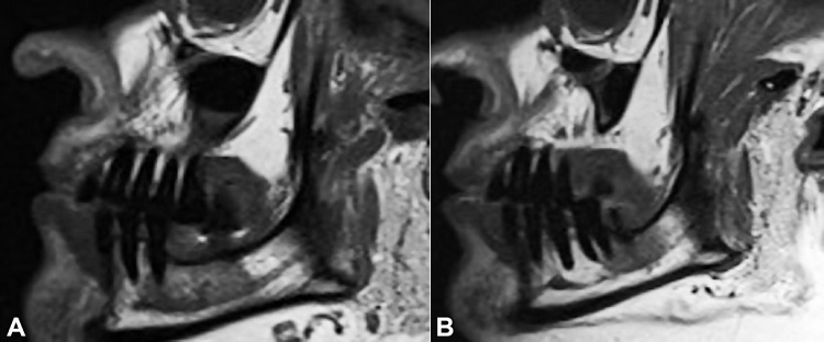 A – Left and B – right sagittal section of MRI (T1 weighed images). In both images, asymmetry of the mandibular canals is observed, with more evidence on the right side