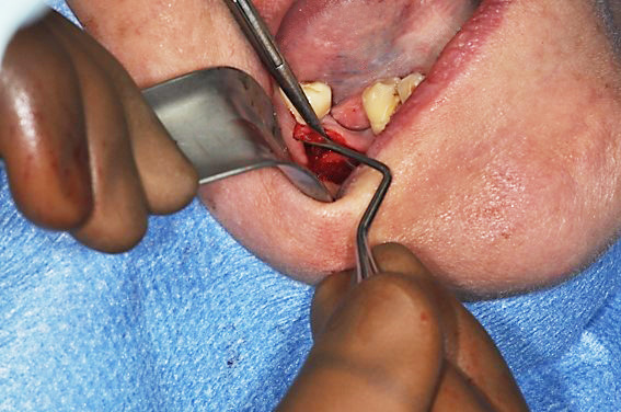 Intraosseous medullar biopsy of the mandible.