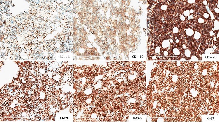 Immunohistochemical profile, revealed positivity for BCL-6, CD-10, CD-20, C-MYC, PAX-5 and strong positivity for Ki-67.