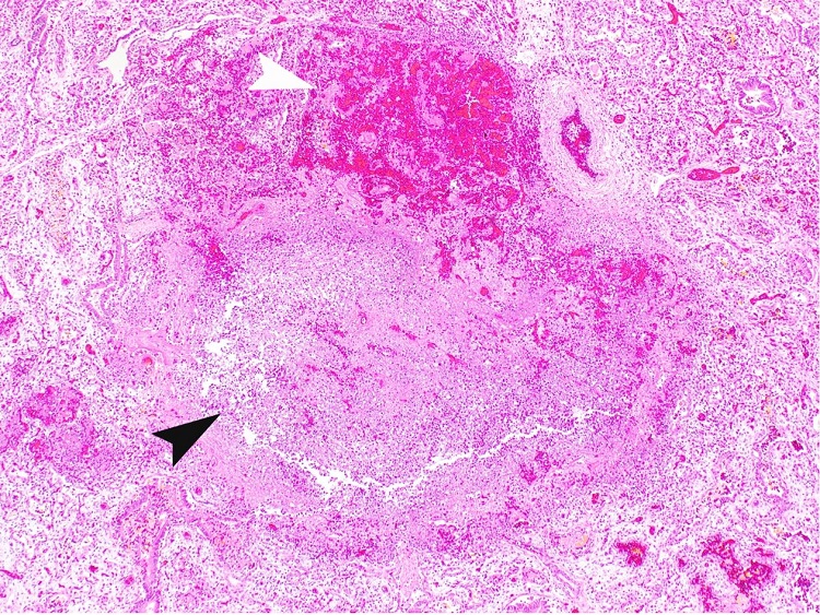 Photomicrograph of the lung. Lung parenchyma with areas of severe hemorrhage (thin white arrowhead) and necrotizing abscess (black arrowhead) (H&E; 4X).
