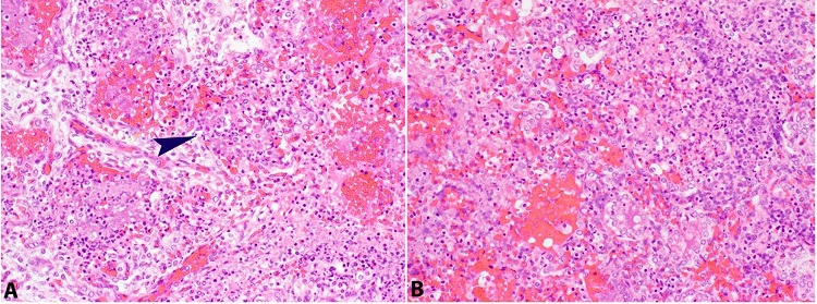 Photomicrographs of the lung. A &ndash; Right lung parenchyma with extensive acute inflammation and fibrin deposition (arrow) (H&E; 20X); B &ndash; Left lung parenchyma with hemorrhage, acute inflammation and fibrin deposition (H&E; 20X).