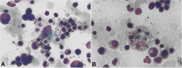 Bone Marrow Biopsy revealing trilineage hematopoiesis with hemophagocytosis. 