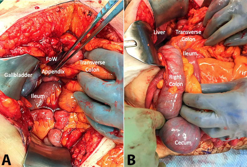 A – Intraoperative findings highlighting cecal herniation through the Foramen of Winslow. The appendix is noted in the right upper quadrant near the gallbladder. The ileum and transverse colon are shown traversing the foramen of Winslow. There is no evidence of the cecum; B – Intraoperative findings post-reduction of cecal bascule herniation through Foramen of Winslow. The cecum and right colon appeared viable.