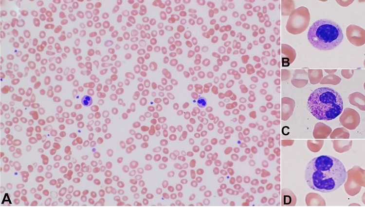 Photomicrograph of the peripheral blood smears showing occasional dysplastic neutrophils. A – The neutrophil in the left is dysplastic, with a bilobed nucleus (pseudo-Pelger-Huët anomaly). The neutrophil in the right is a normal-appearing band. A few teardrop cells are seen; B – A dysplastic neutrophil with a non-segmented nucleus; C – A dysplastic neutrophil with a bilobed nucleus; D – A dysplastic neutrophil with moderately hypogranular cytoplasm. [Wright-Giemsa stain, original magnification, × 1000 (A), × 1000 (B-D].