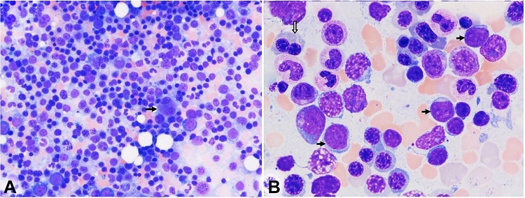 Photomicrographs of the bone marrow aspirate smears. A – Erythroid hyperplasia and some erythroblasts in apoptosis are evident. A dysplastic megakaryocyte is noted, with two separated round nuclei (arrow); B – Blasts (black arrows) are mildly increased. A binucleated erythroid precursor (block arrow) is seen. [Wright-Giemsa stain, original magnification, × 400 (A), × 1000 (B)].