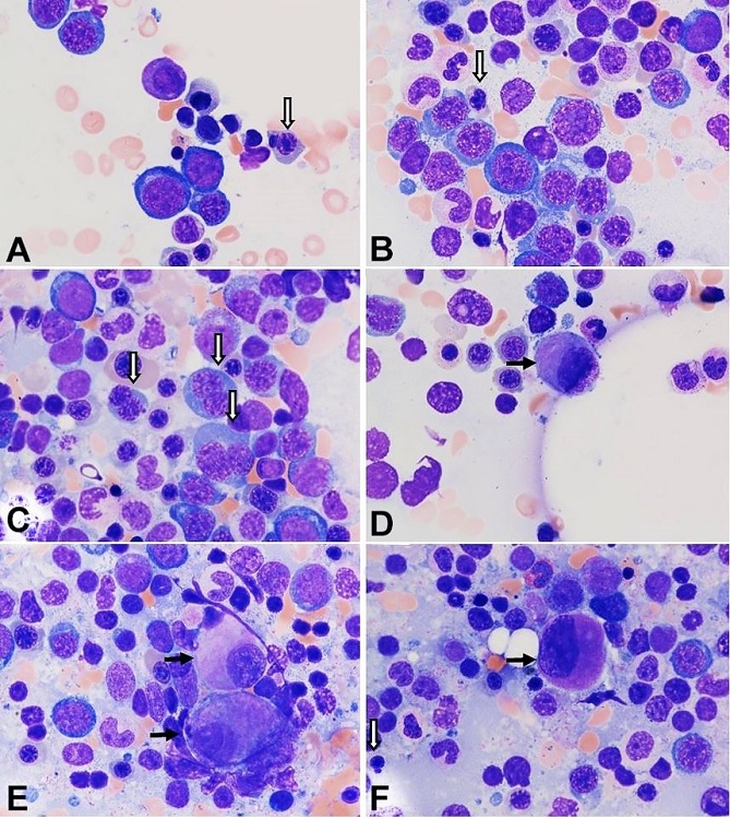 Photomicrograph of the bone marrow aspirate smears show mild dyserythropoiesis and some dysplastic megakaryocytes. There are a few erythroid precursor cells showing dysplastic features including abnormal nuclear budding (A and B), megaloblasts with “nuclei in salami-slice” (B), and binucleation (C). Micromegakaryocytes (D) and megakaryocytes with small non-lobated nuclei (E) are present. F. The megakaryocyte shows asynchronous nuclear-cytoplasmic maturation, with well granulated cytoplasm and a non-lobated immature nucleus. A dysplastic erythroid precursor is also seen. (Block arrows: dysplastic erythroid precursors; black arrow: dysplastic megakaryocytes; Wright-Giemsa stain, original magnification, × 1000).