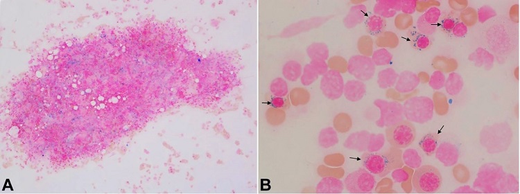 Photomicrograph of the iron stain of bone marrow aspirate showing adequate iron stores (A) with numerous ring sideroblasts (arrows, B). [Iron stain, original magnification, × 100 (A), × 1000 (B)]