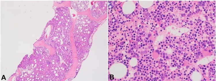 Photomicrograph of the bone marrow biopsy shows a hypercellular bone marrow (A) with trilineage hematopoiesis and erythroid proliferation (B). [H&E, original magnification, × 40 (A), × 400 (B)].