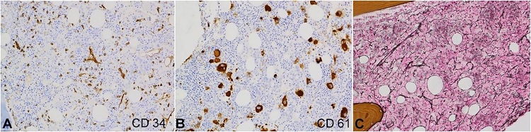 Photomicrograph of the bone marrow biopsy showing increased immature cells, most of which stain positive for CD34 (A). There are many megakaryocytes with various sizes, highlighted by CD61 stain, including several micromegakaryocytes (B). Reticulin stain of the marrow biopsy reveals a mild to moderate increase in reticulin fibers (C). (A-B, immunocytochemical stain, original magnification, × 200; C, reticulin stain, original magnification, × 200).