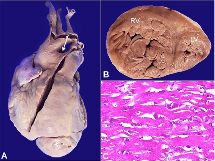 A &ndash; External view: Right ventricle forming the apex indicating severe enlargement. White arrow &ndash; Lack of separation between the aorta and pulmonary trunk; B &ndash; Apical slice indicating severe right ventricular hypertrophy; C &ndash; Microscopy showing hypertrophic cardiac myocytes.