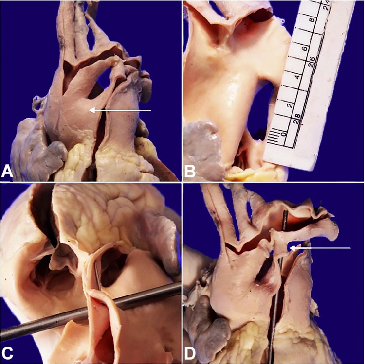 Aortopulmonary window. A &ndash; Anterior view (arrow pointed); B &ndash; Right lateral view showing Type 1 defect; C &ndash; Superior view with the probe placed in the defect and showing intact semilunar valves; D &ndash; Patent ductus arteriosus (Probe placed in situ with an arrow pointed).