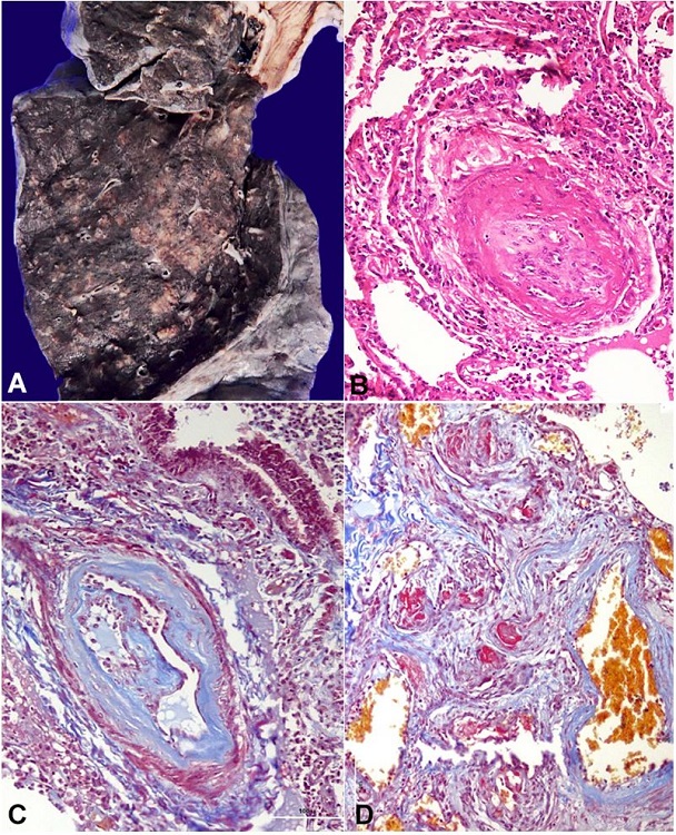 A &ndash; Cut surface of lung shows prominent bronchovascular marking with multiple small nodules; B &ndash; Pulmonary artery hypertension in the form of myointimal proliferation with obliteration of lumen (H&E, 200X); C &ndash; Masson trichrome stain (200X); D &ndash; Plexiform lesion (Masson trichrome, 200X).
