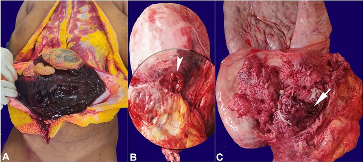 Gross view of the autopsy findings: A &ndash; hematoma in the peritoneal cavity, B &ndash; gravid uterus of 30cm x 18 cm with the thickness of 1 cm at the level of the fundus. The inferior aspect of the anterior wall, along the previous uterine scar, shows a uterine rupture of 1.2 cm in diameter (arrowhead), C &ndash;endometrial surface showing the invasion of the placenta into the myometrium, and serosa with hemorrhage (arrow).