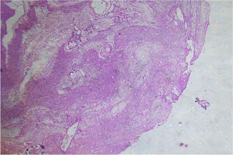Photomicrograph of the uterus, illustrating chorionic villi invading the full thickness of myometrium to the serosa with evidence of rupture. (H&E, x10).