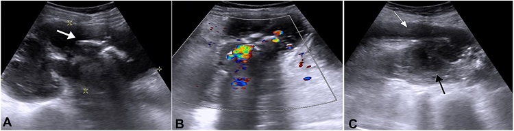 Abdominal USG showing a calculus and left psoas abscess. A and B &ndash; A large calculus probably a staghorn calculus (white arrow) with a twinkling artifact and posterior acoustic shadowing; C &ndash; Dilated proximal left ureter (white arrow) in close contact with a large collection in the left psoas region (black arrow).