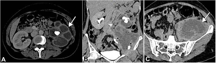 Abdominal CECT axial and coronal section shows XGP of the left kidney. A &ndash; Corticomedullary phase of CECT shows an enlarged left kidney with gross hydroureteronephrosis with thinning of renal cortex and a staghorn calculus within the renal pelvis, which is contracted, whereas calyces are dilated giving the appearance of a &ldquo;Paw of A Bear&rdquo; (white arrow); B &ndash; Excretory phase of CECT shows a staghorn calculus measuring 3.8 &times; 2.4 cm (black arrow) within the renal pelvis. Multiple calculi, the largest measuring 1.6 &times; 1.4 cm (arrowheads), were noted in the ureter and the collection; C &ndash; Large collection within the left iliopsoas muscle consistent with left psoas abscess (white arrow).