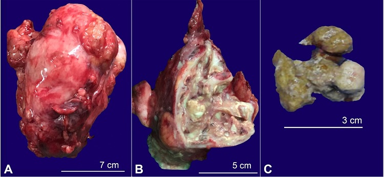 Gross findings of the excised left kidney. A &ndash; Gross view of the left kidney and attached ureter partially covered by perinephric fat; B &ndash; The cut surface of the left kidney. Note the presence of multiple calculi and necrotic cheesy material replacing the renal parenchyma with loss of cortico-medullary differentiation; C &ndash; The staghorn calculus.