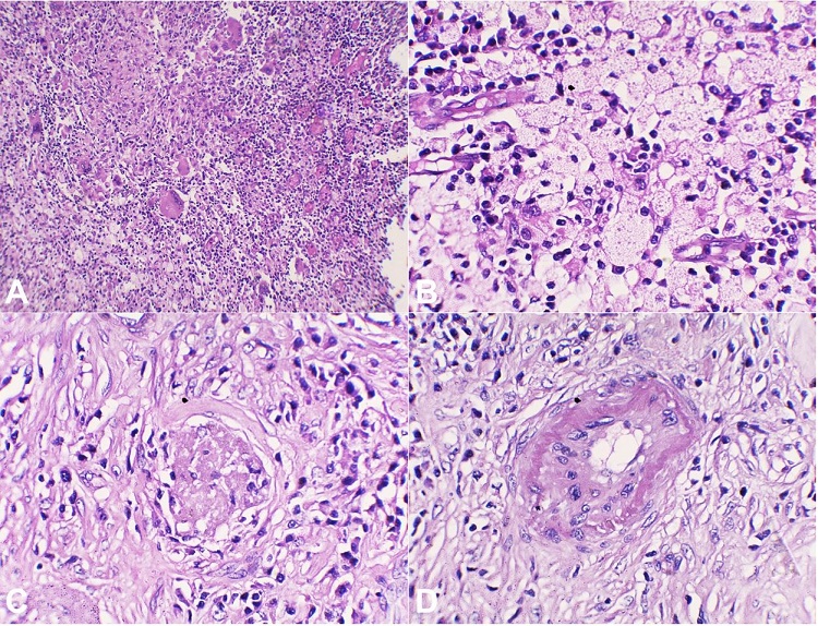 Photomicrographs of the left kidney. A &ndash; Microscopic section showing replacement of the renal parenchyma by sheets of acute and chronic inflammatory cells composed of neutrophils, lymphocytes, and plasma cells, scattered foreign body giant cells (H&E10X); B and C &ndash; Section shows sheets of polygonal histiocytes having abundant pale eosinophilic and foamy cytoplasm with a round nucleus and annexed with focal aggregates of lymphocytes (H&E 40X); D &ndash; Section shows the hyalinised glomeruli and thick-walled blood vessel (H&E 40X).
