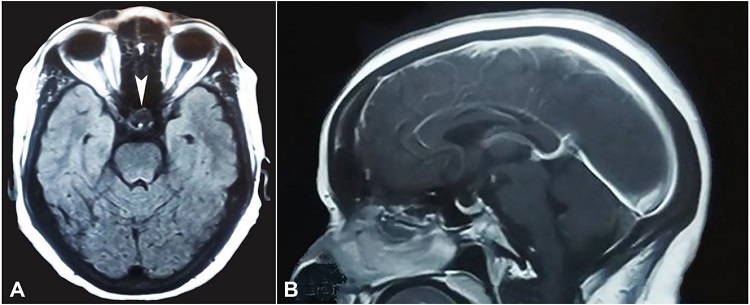 Brain MRI. A – T1W axial, and B – Sagittal Plane - Strongly enhancing a mass lesion measuring 1.7 x 1.4 cm arising from supra sellar region causing compression over optic chiasma without intrasellar or parasellar extension (arrowhead).