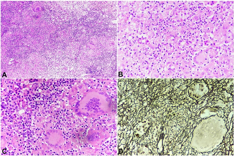 Photomicrograph of the pituitary gland. A – Many well-formed epithelioid granulomas (H& E: 100x); B – Well-formed epithelioid granulomas, Langhans giant cells, along with pituitary parenchymal cells (H&E: 400x); C – Granulomas with pituitary parenchymal cells (H& E: 400x); D – Reticulin stain: Well preserved pituitary acinar structure (400X).