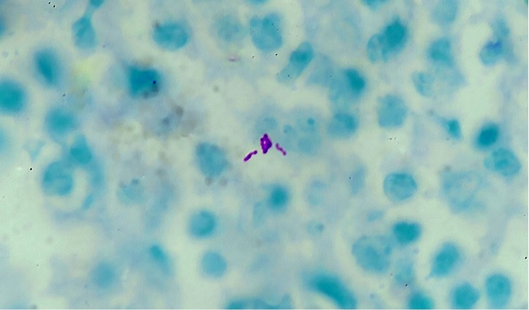 Photomicrograph of the pituitary gland showing acid-fast bacilli (Ziehl Neelsen stain, 1000x).