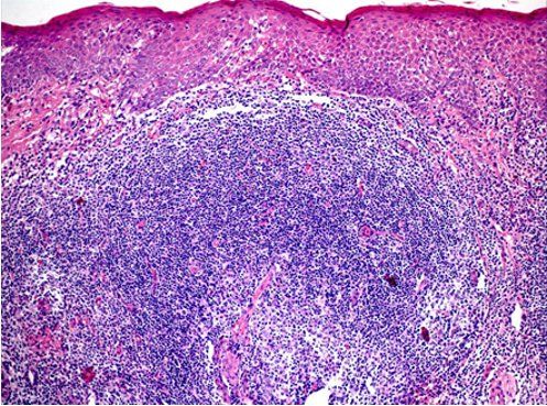 Histopathological features of actinic prurigo cheilitis.