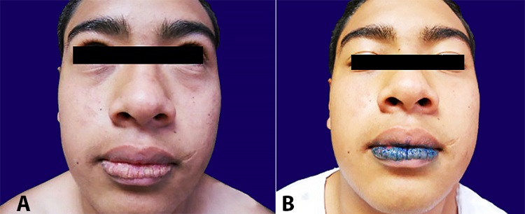 A &ndash; Clinical aspects of actinic prurigo cheilitis; B &ndash; Persistent staining with toluidine blue after removing dye with 2% acetic acid (positive zone).