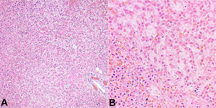 Microscopic image of liver showing patchy areas of necrosis (H&E; 20x in A and 40x in B).