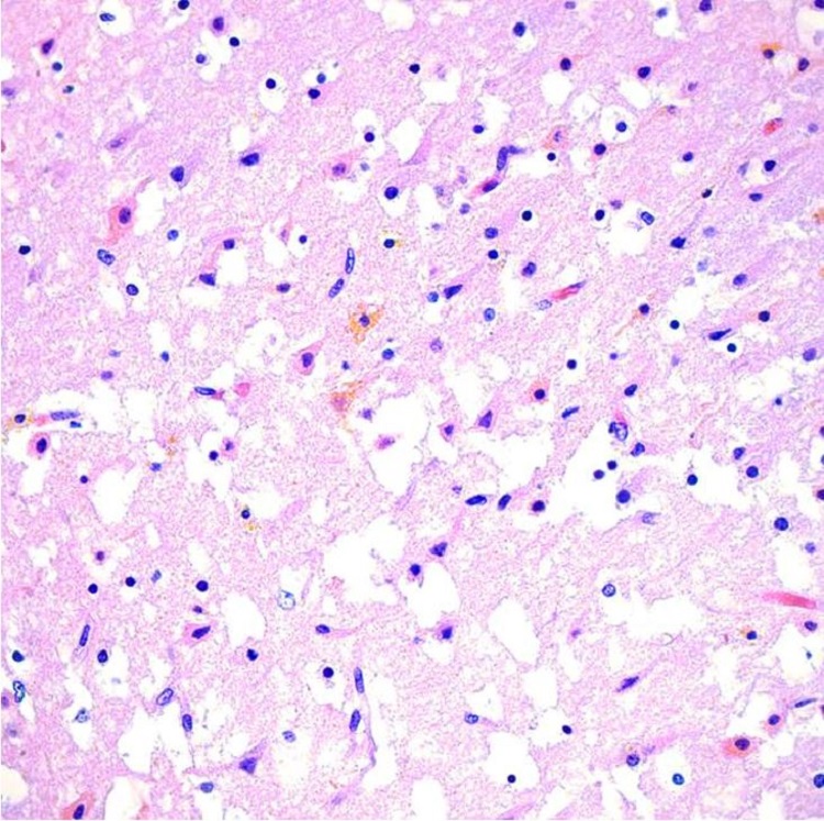 Microscopic image of the cerebral hemisphere showing extensive vacuolation, gliosis, numerous neurons with cytoplasmic eosinophilia and nuclear pyknosis, associated with yellow-orange cytoplasmic pigment deposition (H&E, 40x).