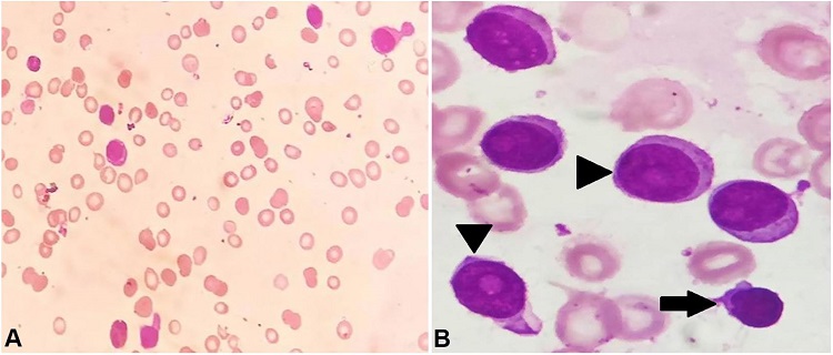 A &ndash; Photomicrograph of peripheral blood smear showing lymphocytosis comprising atypical lymphoid cells; B &ndash; Photomicrograph of bone marrow aspirate exhibiting dual population of atypical lymphoid cells &ndash; small CLL lymphocyte (arrow) and prolymphocytes (arrowheads) [Leishman stain (A) X400, (B) X1000].