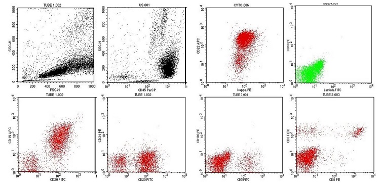 Flow cytometric analysis exhibiting predominance of the lymphoid population which was gated on the CD 45 vs Forward Scatter vs Side Scatter plot. The gated events (63%) demonstrated a CD 19++, CD 20++, CD 22++ clone for light chain kappa and negativity for CD 34, CD 10, CD 103, lambda, surface CD 3, CD 8, CD 4 (not shown) and CD 11c (not shown).