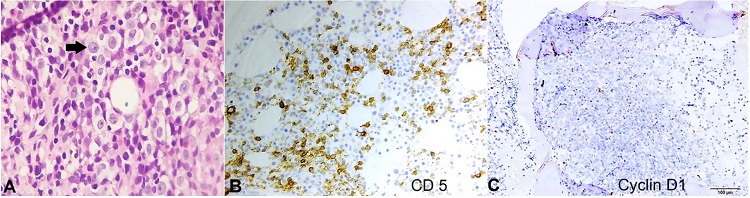 A &ndash; Photomicrograph of bone marrow biopsy revealing diffuse infiltration by dual population of atypical lymphoid cells, the prolymphocytes (arrow) and the small lymphocytes. IHC demonstrating reactivity of the lymphoid cells for CD 5 in B, and negativity for Cyclin D1 in C (A &ndash; H & E, X400; B &ndash; X400; C &ndash; X100).