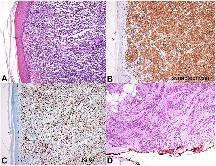 Photomicrograph of the skin. A &ndash; The lesion had a solid growth pattern (H&E, 100X); B &ndash; It was diffusely positive for synaptophysin (100X); C &ndash; Ki67 index was high (100X); D &ndash; The tumor was present in the surgical margin (notice tumor cells present at the red-inked margin) (H&E 200X).