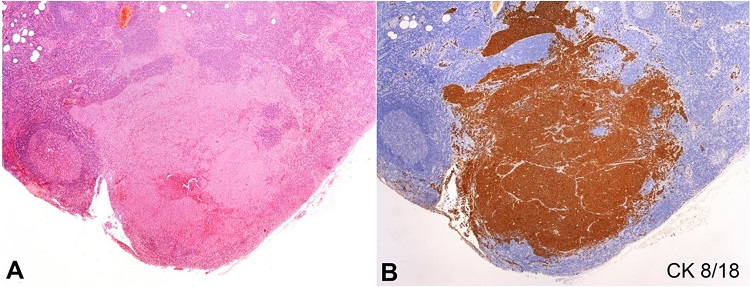 Photomicrograph of the lymph node showing in A &ndash; metastatic infiltration (HE, 200X); B &ndash; positive reaction for CK 8/18 (40X).