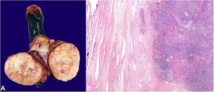 Macroscopic aspect (A) and histological overview (B) of the Merkel cell carcinoma within the testis. A &ndash; The lesion was solid, tan, with foci of hemorrhage and necrosis, and replaced almost the entire testicular parenchyma, sparing the mediastinum testis; B &ndash; The lesion was well demarcated and confined to the testicular parenchyma, sparing the rete and mediastinum testis. Vascular invasion was easily identifiable (white arrow).