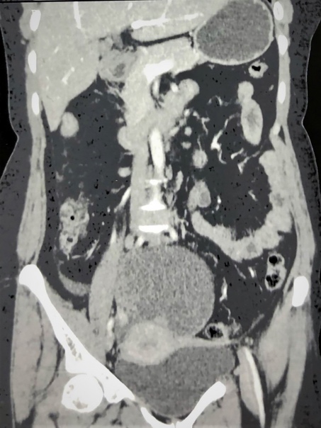 Magnetic resonance imaging (T1 weighted) shows a solid cystic ovarian mass with internal septations.