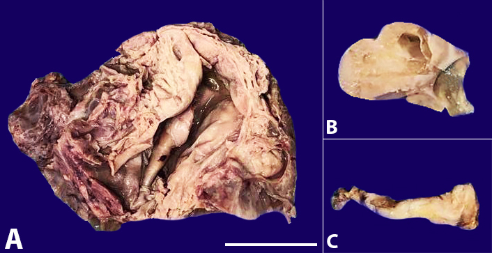 A &ndash; The cut surface of the right and left ovary shows a solid-cystic lesion with areas of necrosis (Scale bar: 3 cm); B &ndash; left ovary; C &ndash; thickened gallbladder wall.