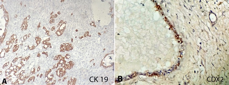 Photomicrographs of the ovary tumor. A &ndash; tumor cells positive reaction for cytokeratin 19 (40x); B &ndash; CDX2 shows nuclear staining in tumor cells (400x). 