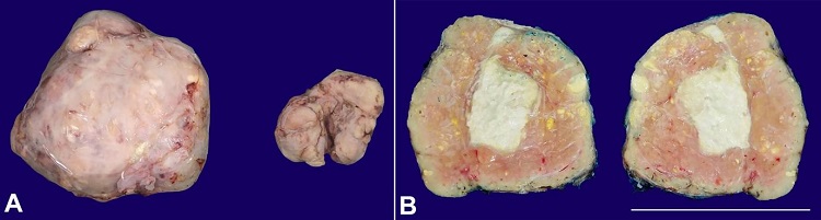 Gross view of the surgical specimens. A &ndash; External surface; The larger mass measured 11 x 10 x 6 cm, while the smaller mass measured 3.0 x 4.5 x 2.0 cm. Both were well-defined brown and lobulated nodules with pseudo-capsule. B &ndash; Cut section of the larger mass; Heterogeneous solid mass with small peripheral cysts and central, white chalk-like necrotic area (scale bar = 11 cm).